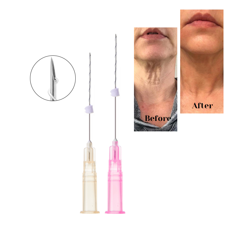 PLLA Mono Screw Threads 26G