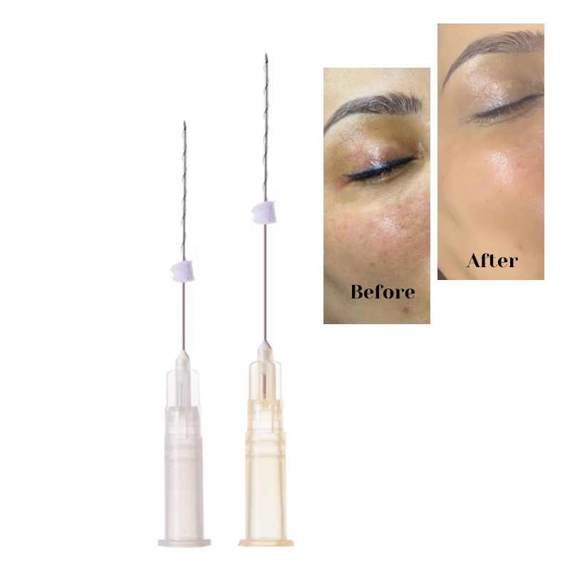 PLLA Tornado Screw Threads